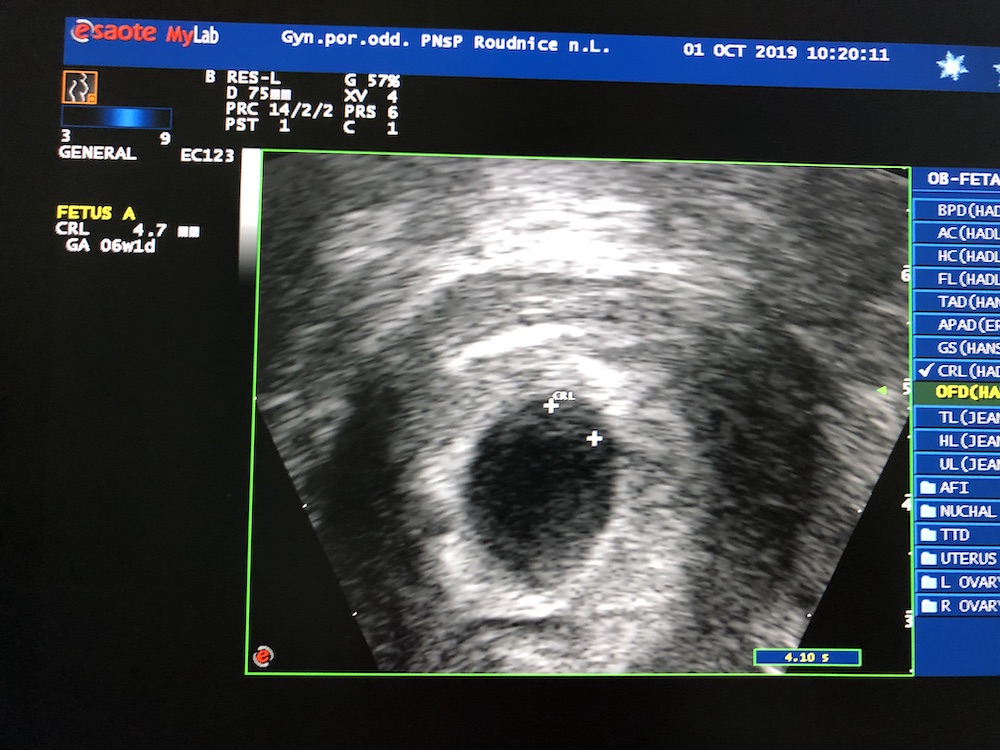 Prvý ultrazvuk v 6 týždni plod má 4,7 mm - tehotenstvo je potvrdené
